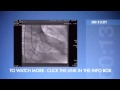 ORLive Express - Coronary Stent Procedure