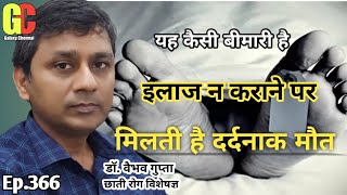 टी.बी. कारण,लक्षण,जोखिम,उपचार - टीबी के कितने प्रकार होते है- Types of Tuberculosis in Hindi- Ep.366