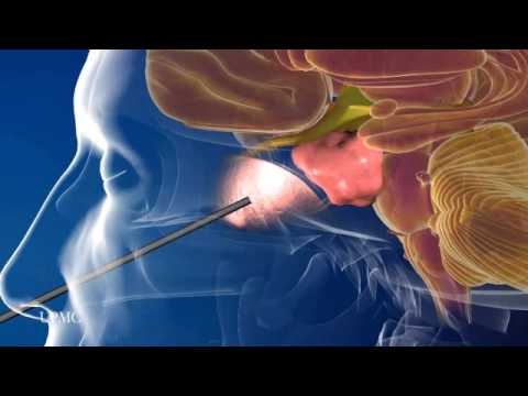 Minimally Invasive Brain Surgery: Endoscopic Endonasal Approach | UPMC ...