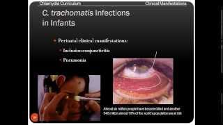 Chlamydia infection