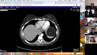 Large retroperitoneal mass - Aarti Sekhar | Liposarcoma