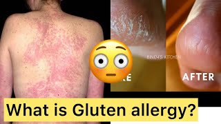 എന്താണ് gluten allergy?. ഇത് ആർക്കൊക്കെ ഉണ്ടാവാൻ സാധ്യത ഉണ്ട്?.#farzasfairy