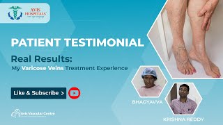 Real Results: My Varicose Veins Treatment Experience at Avis Hospitals | Testimonial