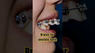 Braces for overbite teeth transformation #braces #orthodontist #dentist