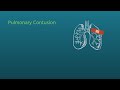 Chest Trauma: Pulmonary Contusion