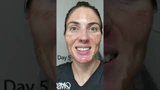 20% TCA Chemical Peel - Wait until the end!  Results before your eyes. Melasma & acne scar treatment
