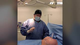 Breast Augmentation Bilateral Patient 7