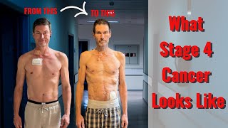 The Devastating Effects Of Stage 4 Cancer