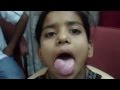 Cancer Tongue 1 Squamous Cell Carcinoma Tumor.MP4