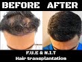 f.u.e u0026 n.i.t hair transplantation dr. zekeriya kul