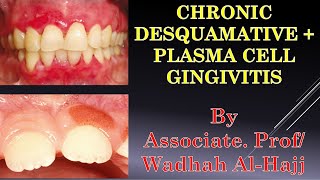 12-Periodontal diseases-2(Desquamative-Plasma cell gingivitis) Wadhah Periodontology lectures.د.وضاح