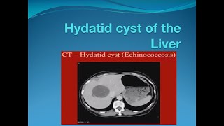 Hydatid cyst of the liver