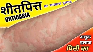 शीतपित्त, पित्ती का अचूक इलाज ! || Urticaria Treatment || Dr. Madhusudan