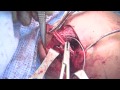 ac joint reconstruction dr. richard hawkins