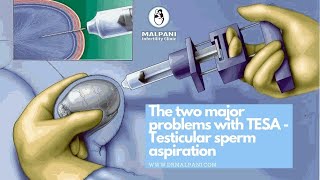 The 2 Major Problems with TESA (Testicular Sperm Aspiration) #drmalpani #malpaninifertilityclinic