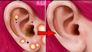 😍ASMR Satisfying | Ear pimple Blackhead car | ear exfoliation Animation | ASMR Animation
