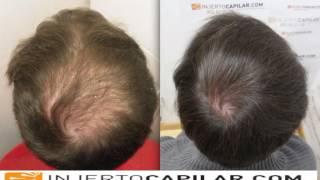 3601 FU's. Hair Transplant by FUE Technique. Diffuse Alopecia. Injertocapilar.com. 563/2012