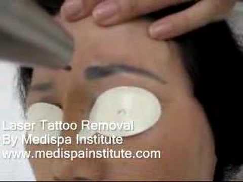 Laser Tattoo Removal Eyebrow Youtube
