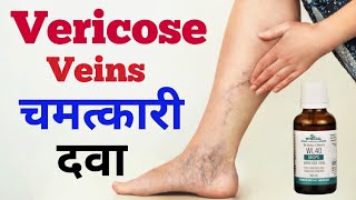 Vericose Veins से परेशान हैं ? ये दवा लीजिए और असर देखिए l Wheezal WL 40 Drops Homeopathic In Hindi