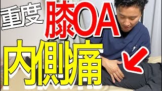 【内側痛】重度の膝OAに対する膝治療