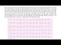 video 4 stemi ekg trong nhồi máu cơ tim có st chênh lên