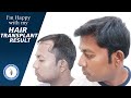 9 Months Result Of Hair Transplant Surgery || Hairfree & Hairgrow Clinic Gurugram Branch.