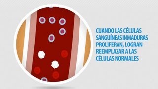 Informacion de la Leucemia