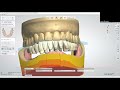 on demand webinar designing premium dentures in 3shape part three of a three part series