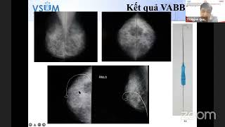 2.4 Ứng dụng lâm sàng của siêu âm trong điều trị bệnh lý tuyến vú (TS.BS. Huỳnh Quang Khánh)