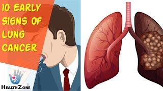 10 Early Signs Of Lung Cancer