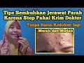 Mengatasi Breakout Setelah Lepas Krim Dokter