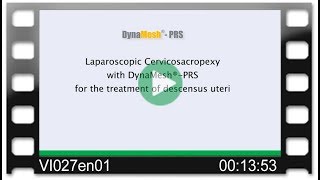 DynaMesh®-PRS - OR-Video: Laparoscopic Cervicosacropexy for the Treatment of Descensus Uteri