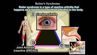 Reiter's Syndrome Reactive Arthritis - Everything You Need To Know - Dr. Nabil Ebraheim