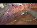 robotic repair of left sided spigelian hernia