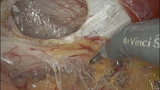 Robotic Repair of Left Sided Spigelian Hernia