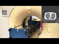 injecting and removing cancer from ct scans