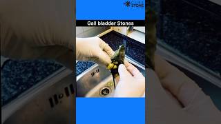 Gall bladder Stones | Laproscopic cholecystectomy | How gall bladder stones are removed