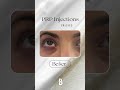 before u0026 after results of prp injections for brighter firmer eyes