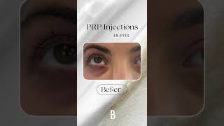 Before \u0026 After Results of PRP Injections for Brighter, Firmer Eyes!