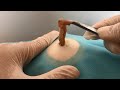 Big Cystic Acne Blackheads Extraction Blackheads & Milia, Whiteheads Removal Pimple Popping