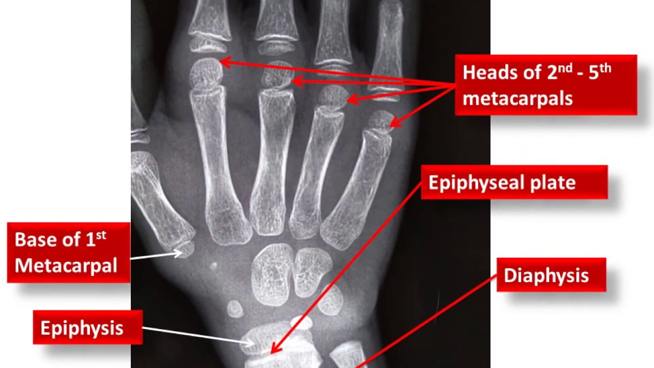 X Ray Bone Age Chart