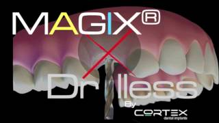 MAGIX impalnt the only implant for Drill-Less approach in a Narrow Ridge