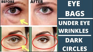 🛑 FACE YOGA FOR EYE BAGS | DARK CIRCLES | PUFFY EYES | EYE WRINKLES | GET RID OF EYE BAGS