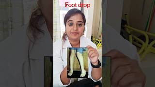 foot drop|கணுக்கால் தளர்ச்சி #physiotherapy #youtubeshorts #treatment #trending #youtube #rehab#foot