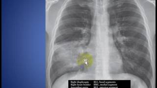 Radiology Rounds 10 Useful chest Signs - Silhouette Sign