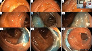 Serrated Colon Lesions: How Best to Manage?