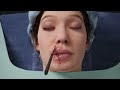 Medical Procedure - Z-Plasty with VY-Advance Surgery Animation