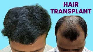 Hair Transplant India | Best Hair Transplant Results | Raipur Hair Transplant Clinic |
