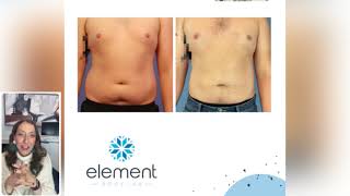 CoolSculpting Before and After Results | Element Body Lab | Dallas, Texas