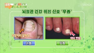 손톱 무좀? 뇌혈관 위험 신호다?! [내 몸 사용설명서] 240회 20190222